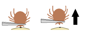 Removing a Tick with Tweezers